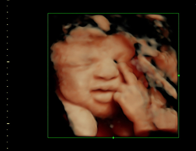 3D ultrasound image at 33 weeks